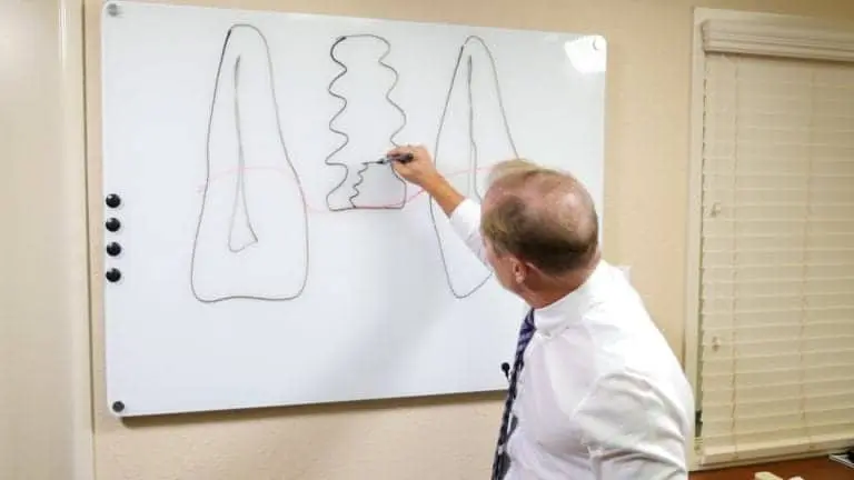 Dental Implant Crown and Bridge Options