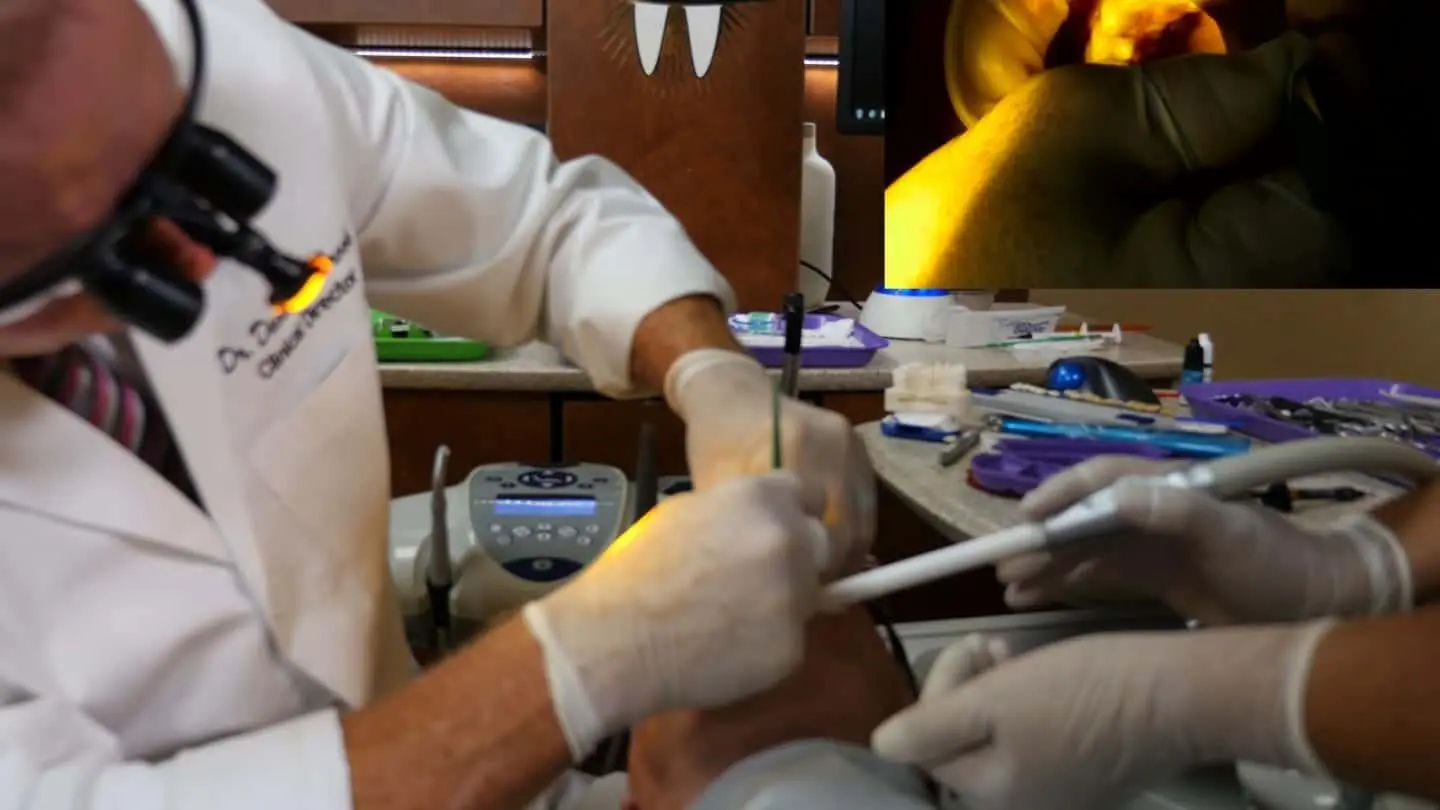 PFM Anterior Crowns With High Esthetic Zirconia