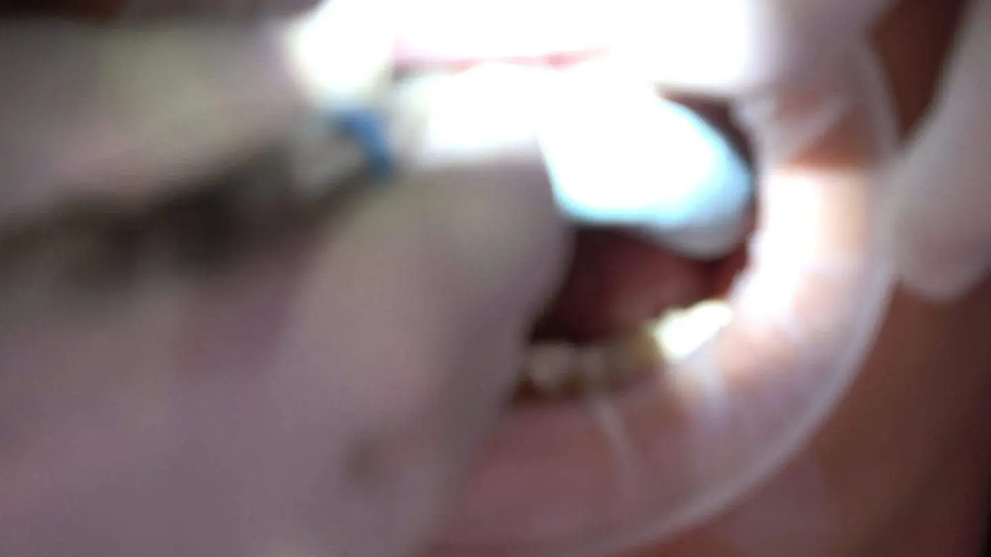 matrices for quality veneer prep