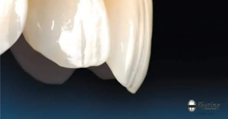 A Dental Case Study: Impression Techniques for Single