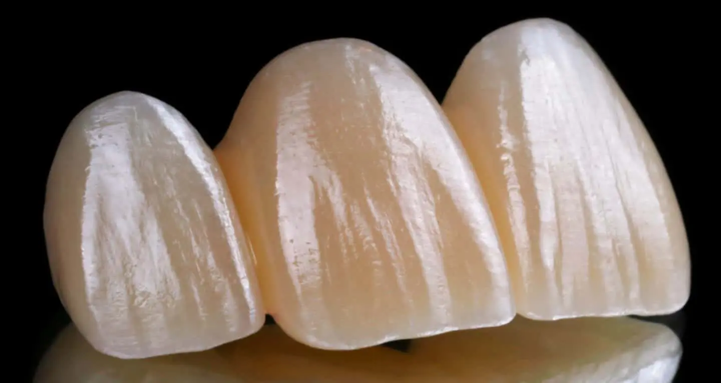 Bruxer Aesthetic Bridge_9998