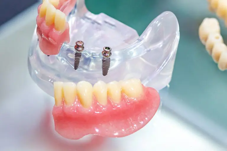 implant dentures