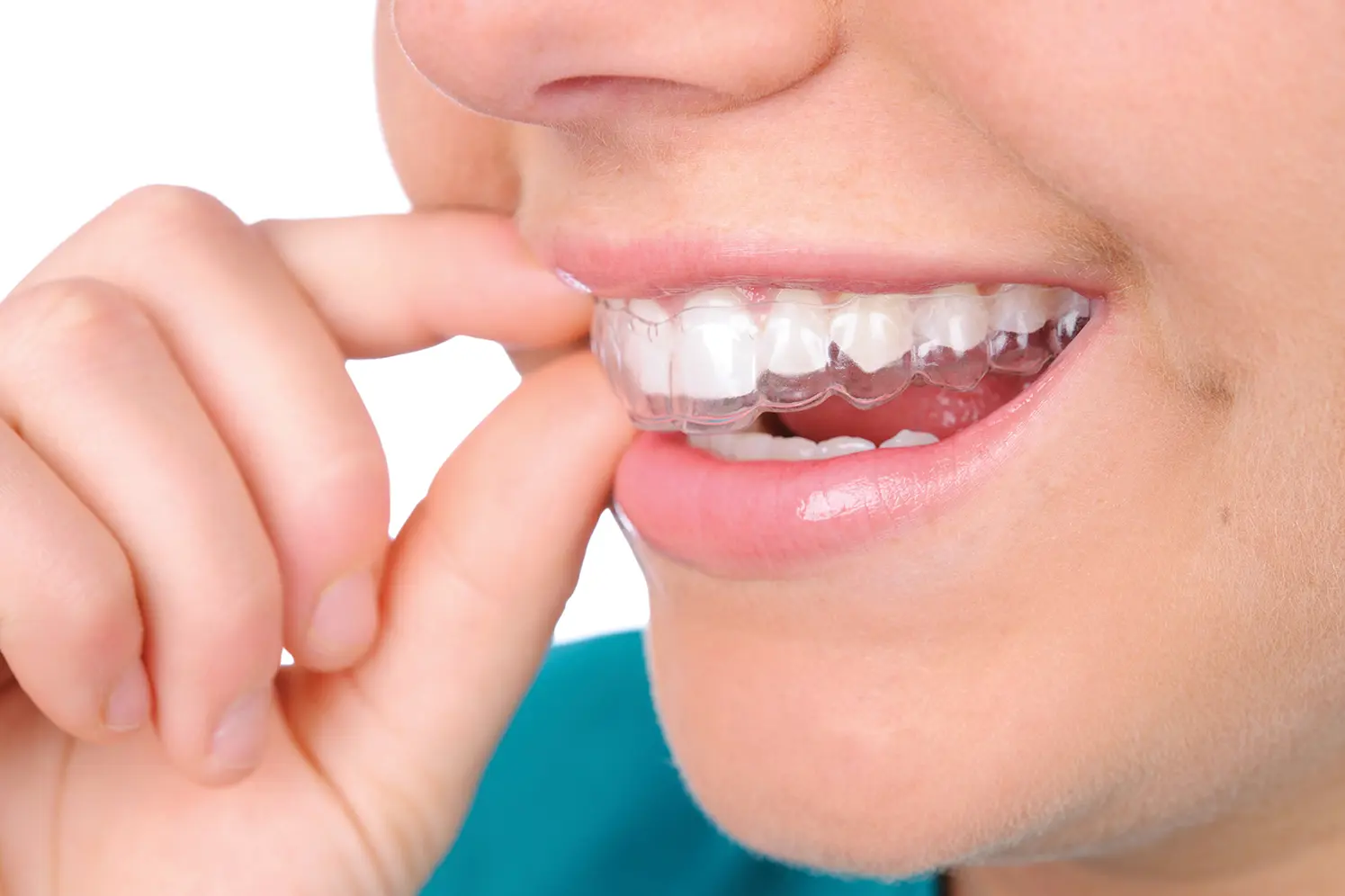 Person putting in a retainer.PLEASE CLICK ON THE IMAGE BELOW TO SEE MY MEDICAL TECHNOLOGY LIGHTBOX:
