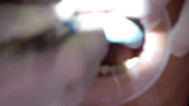 matrices for quality veneer prep